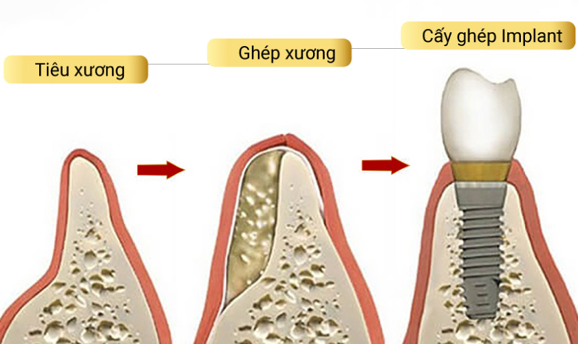 Ghép xương giúp khôi phục xương hàm và tạo điều kiện thuận lợi để cấy ghép Implant