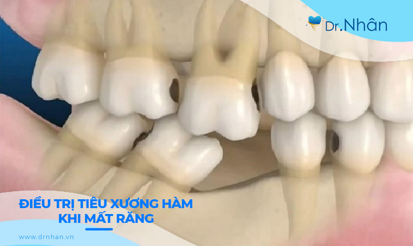 Điều trị tiêu xương hàm khi mất răng