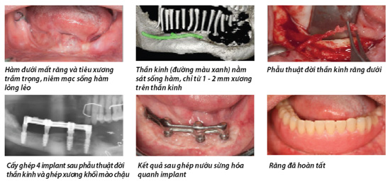 Phẫu thuật dời thần kinh hàm răng dưới