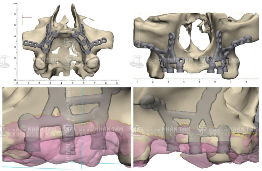 Cấy ghép Implant cá nhân hóa sử dụng khung kim loại và trụ Implant đặt dưới nướu và trên đỉnh xương hàm