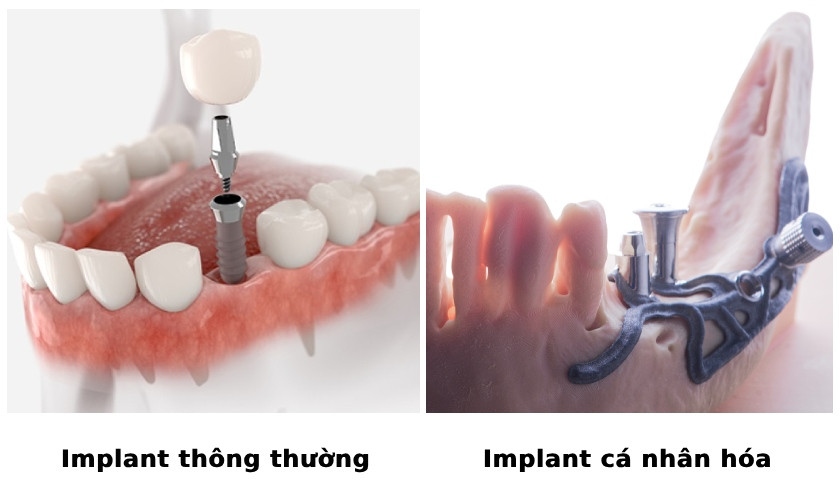 Implant cá nhân hóa cho trường hợp bị tiêu xương nghiêm trọng