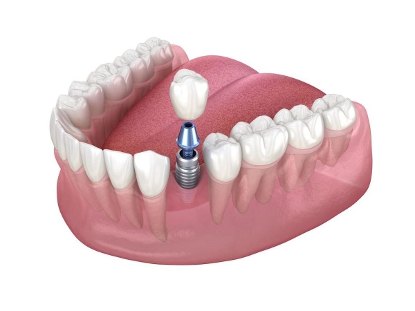 Cấy ghép Implant là giải pháp tối ưu nhất giúp khôi phục răng mất