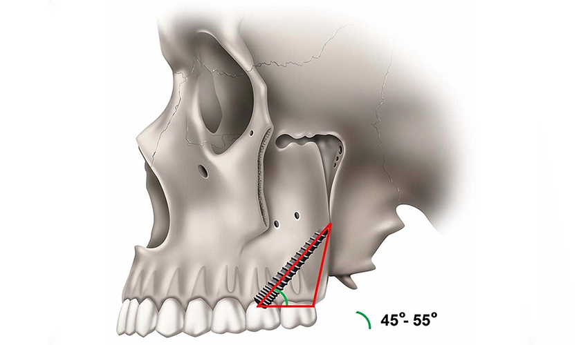 Hình ảnh Implant Pterygoid được neo ở một góc 45 độ