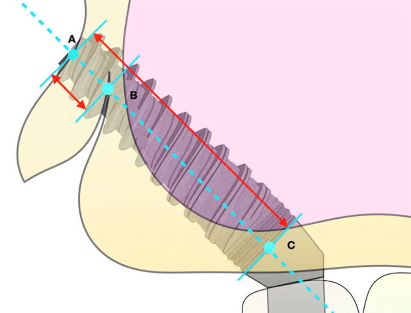 Implant Pterygoid đi qua 3 vùng xương: xương lồi củ, xương khẩu cái và xương bướm