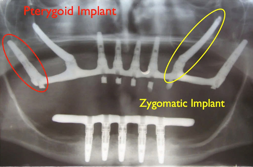 Kết hợp Implant Zygoma và Implant Pterygoid