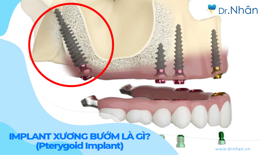 Implant xương bướm (Pterygoid Implant) là gì?