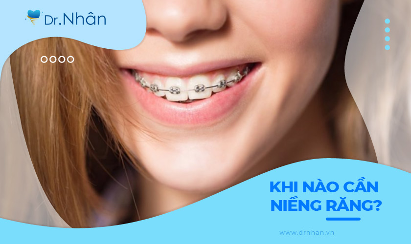 Khi nào cần niềng răng: Những dấu hiệu cần biết