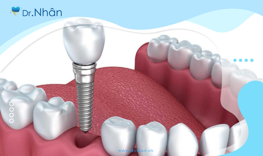  Làm răng Implant có đau không? Mất bao lâu để phục hồi?