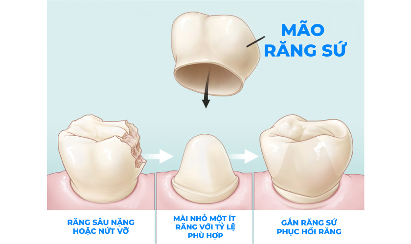 Bọc răng sứ giúp phục hồi chiếc răng bị hỏng do sâu hoặc nứt, vỡ