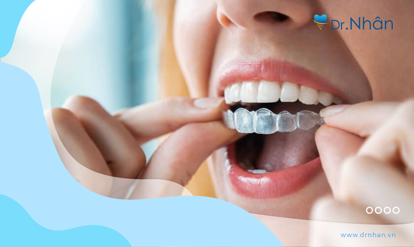 Niềng răng invisalign có tính thẩm mỹ cao