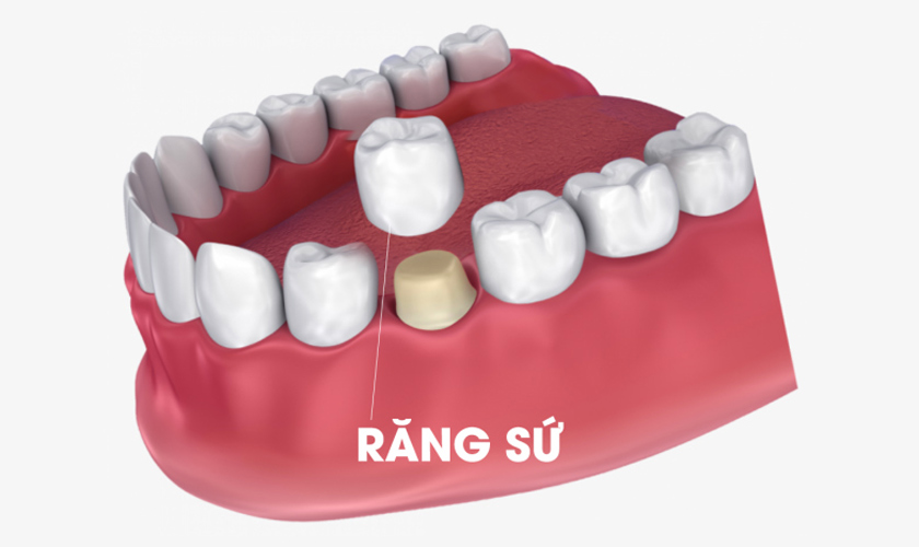 Bọc răng sứ giúp bạn sở hữu hàm răng đều đẹp, trắng sáng