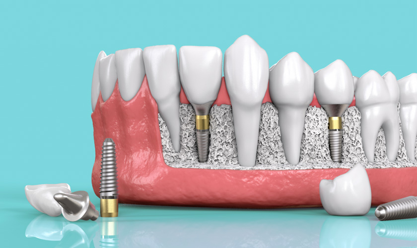 Cấy ghép răng Implant