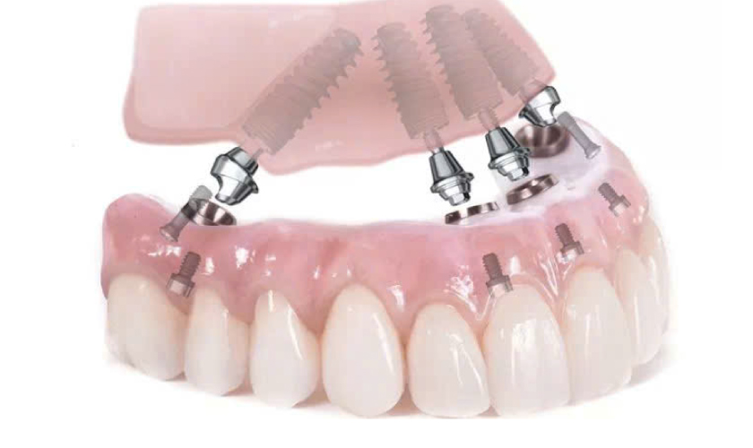 Cấy ghép Implant phục hồi chức năng nhai và thẩm mỹ