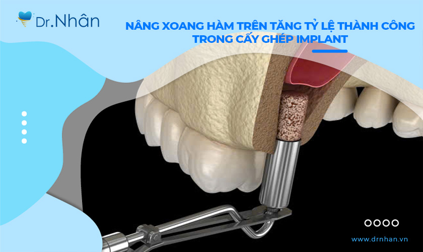 Nâng xoang hàm trên tăng tỷ lệ thành công cấy ghép Implant