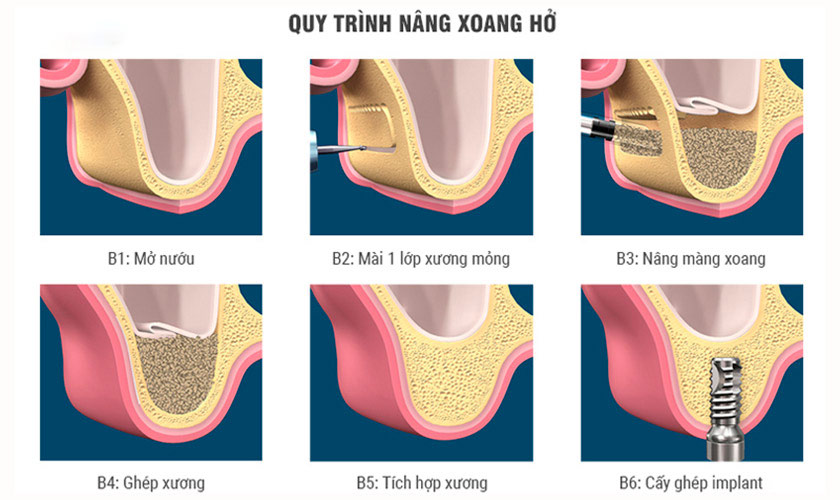 Quy trình nâng xoang hở tại Nha khoa Nhân Tâm