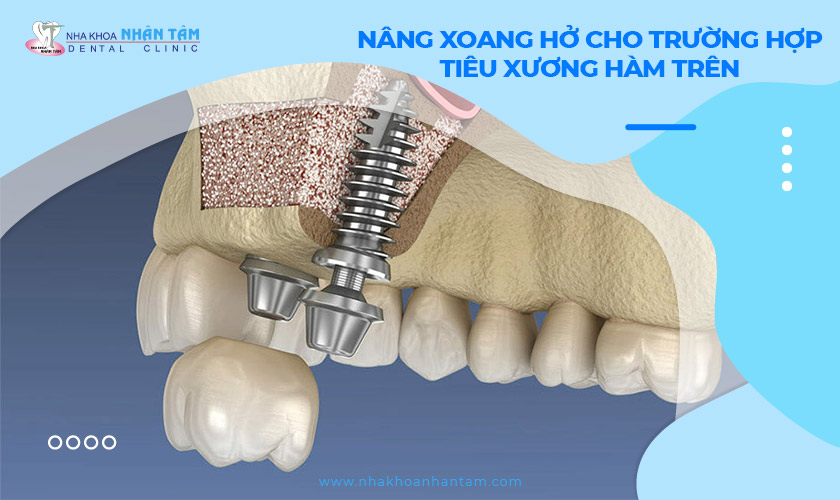 Nâng xoang hở: Giải pháp cho trường hợp tiêu xương hàm trên