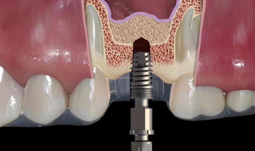 Nâng xoang tạo điều kiện thuận lợi cho cấy ghép răng Implant