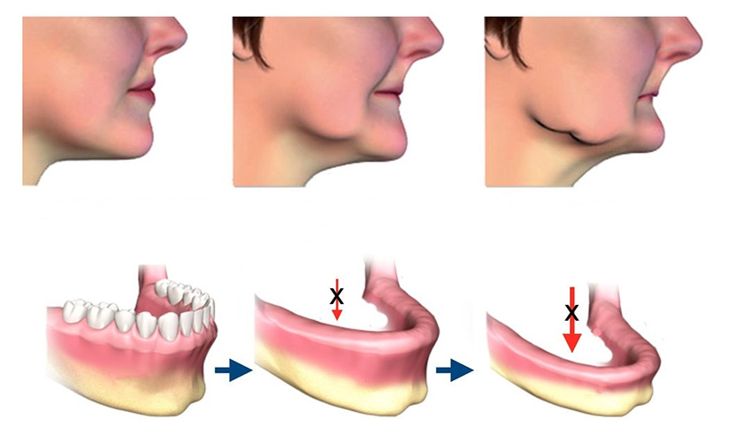 Các trường hợp tiêu xương cần nâng xoang - ghép xương