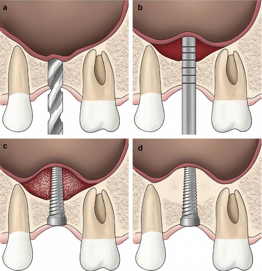 Nâng xoang kín ít xâm lấn, có thể cấy ghép Implant cùng lúc