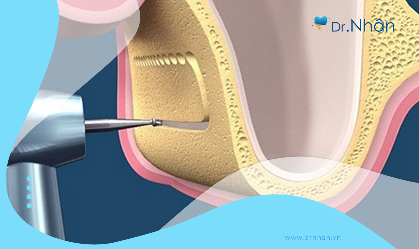 Nâng xoang hở phù hợp với các trường hợp tiêu xương nặng