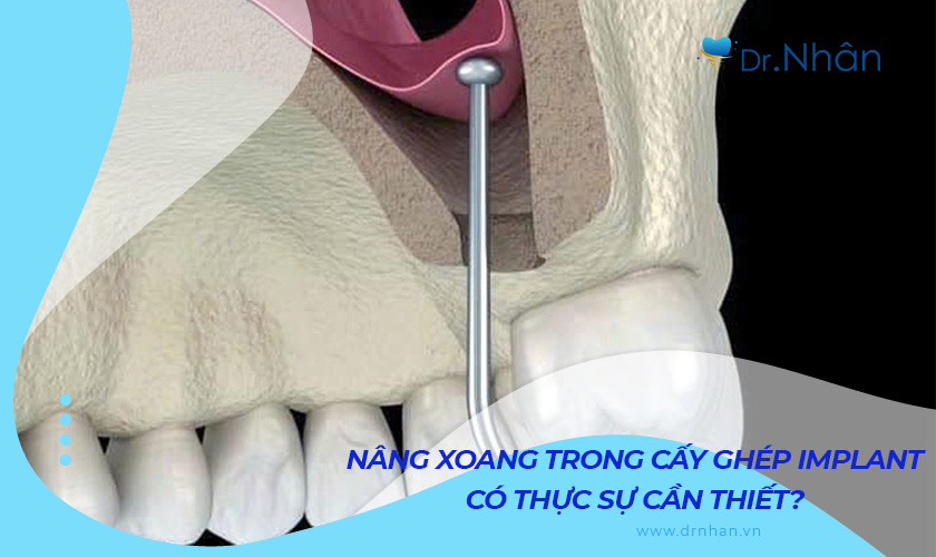 Nâng xoang trong cấy ghép Implant có thực sự cần thiết?