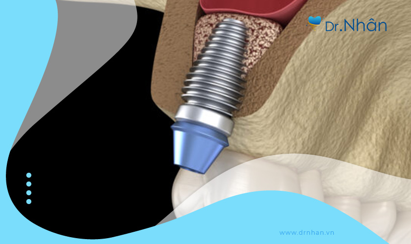 Nâng xoang trong cấy ghép Implant