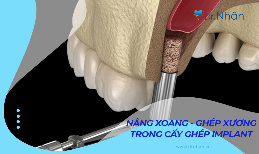 Nâng xoang và ghép xương trong cấy ghép Implant