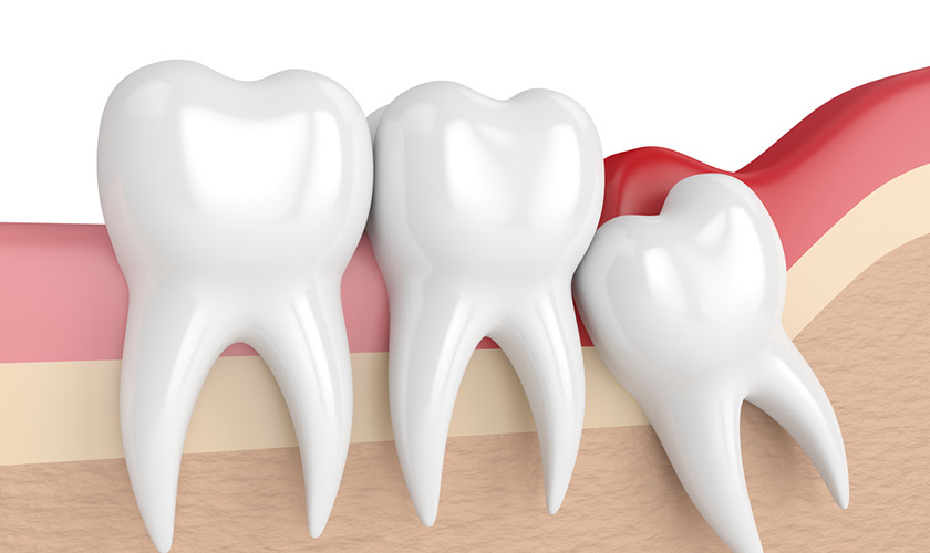 Tình trạng răng khôn mọc lệch ảnh hưởng răng số 7