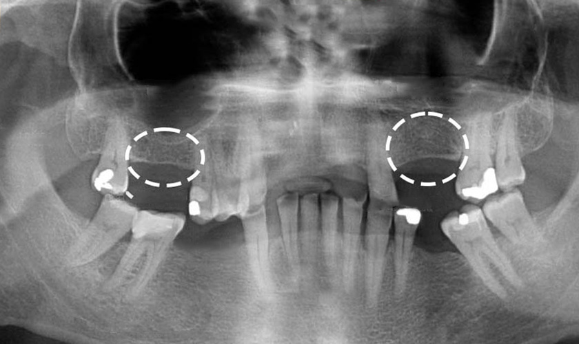 Tiêu xương hàm trên nghiêm trọng gây cản trở cấy ghép Implant truyền thống