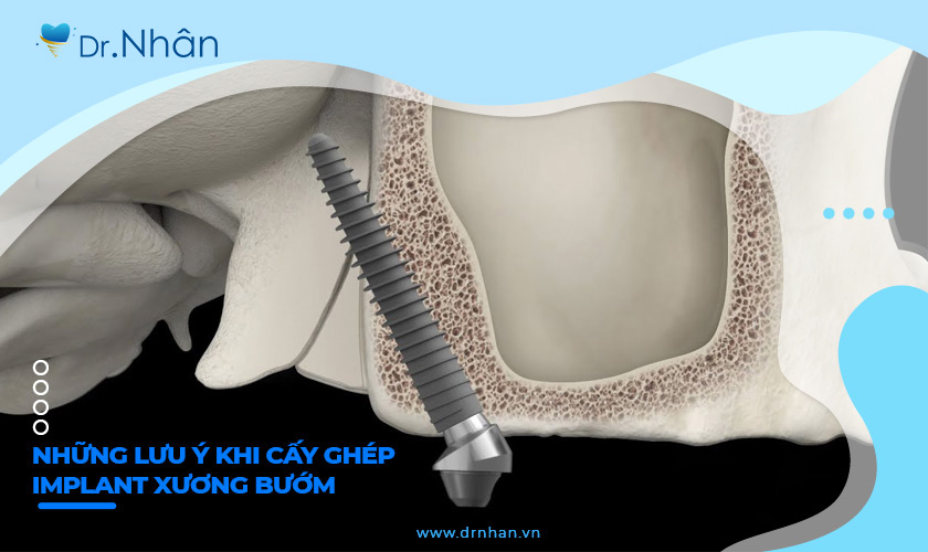 Những lưu ý khi cấy ghép Implant xương bướm