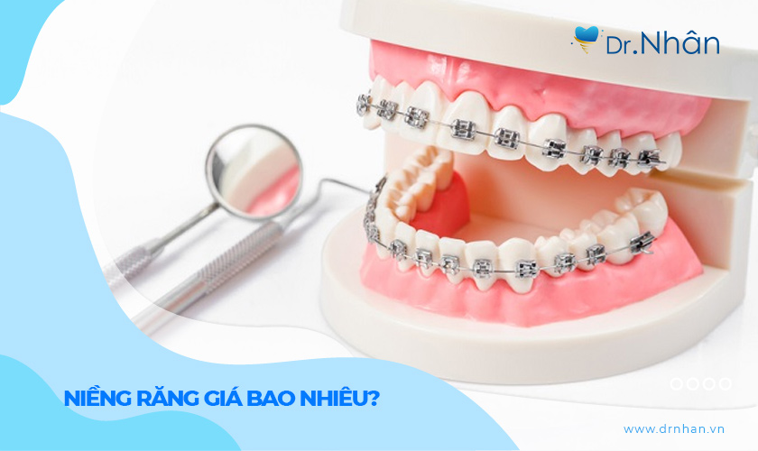 Niềng răng bao nhiêu tiền? Bảng giá niềng răng mới nhất 2024 