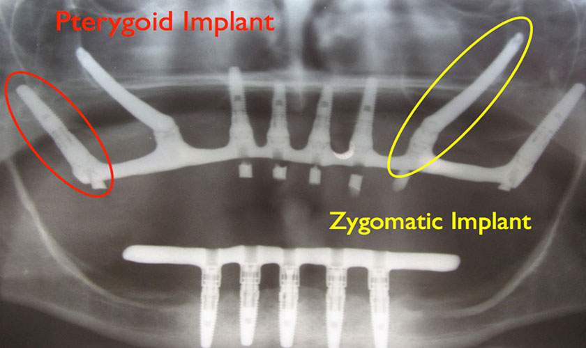 Cải thiện tình trạng mất răng toàn hàm với 2 kỹ thuật Implant