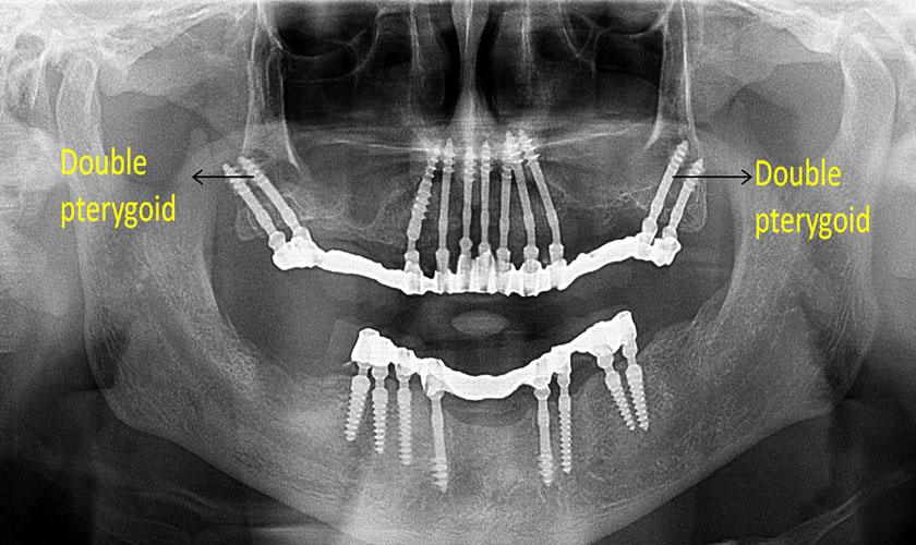 Bệnh nhân cấy ghép Implant xương bướm