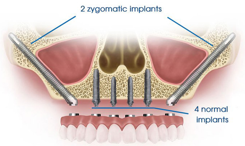 Kỹ thuật cấy ghép Implant xương gò má