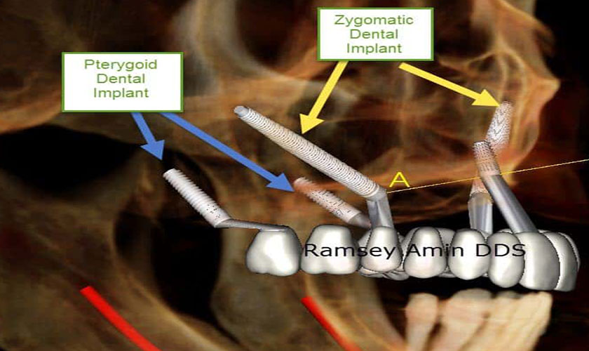 So sánh sự khác nhau giữa Implant xương bướm và Implant xương gò má