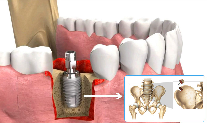 Ghép xương tự thân lấy xương ở vùng hông, cằm, … để ghép vào trong xương hàm