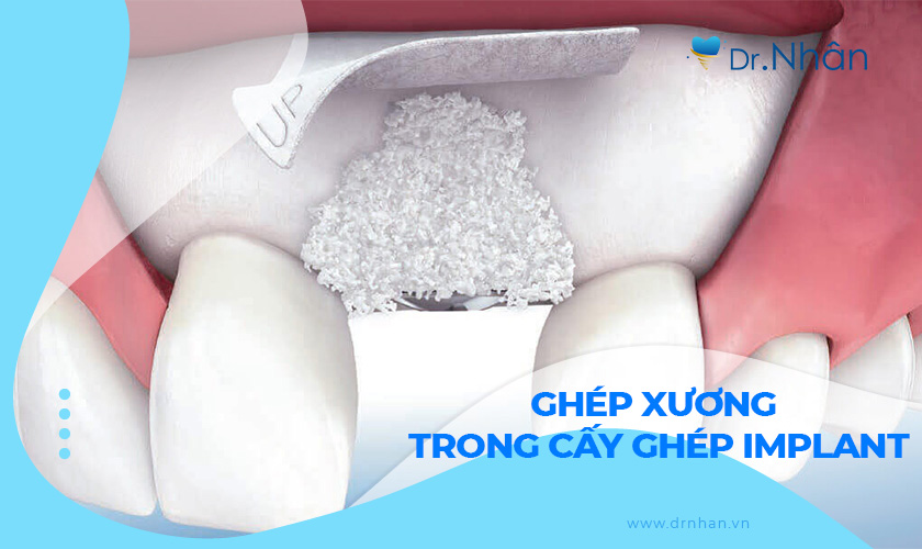 Phẫu thuật ghép xương trong cấy ghép Implant