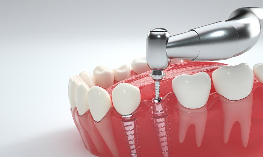 Phương pháp trồng răng Implant an toàn