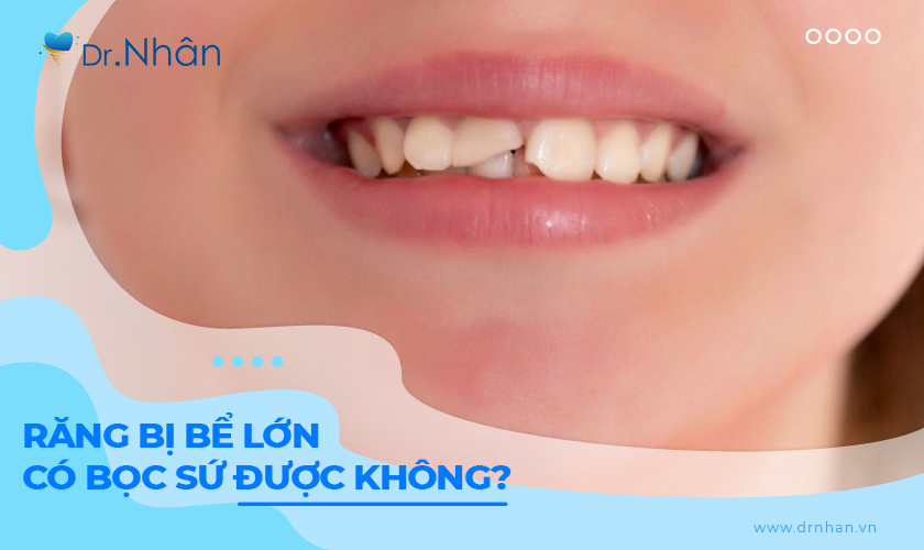 Răng bị bể lớn có bọc sứ được không?