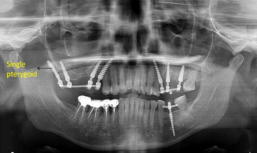 Phương pháp cấy ghép Implant chân bướm hay Implant Pterygoid