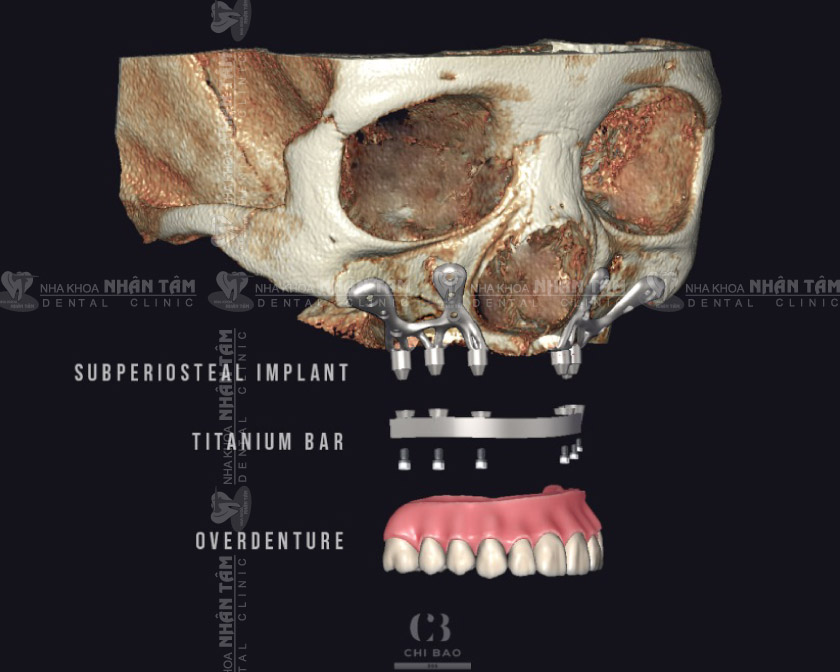 Implant cá nhân hóa