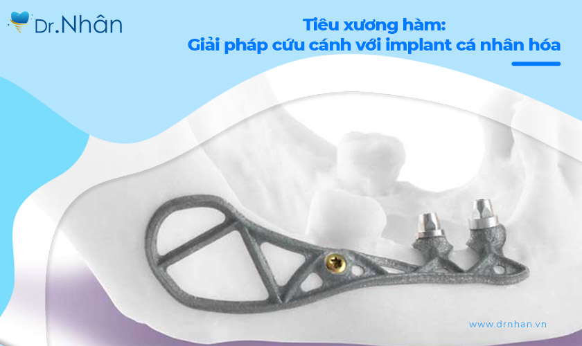 Tiêu xương hàm trầm trọng: Giải pháp “cứu cánh” với implant cá nhân hóa