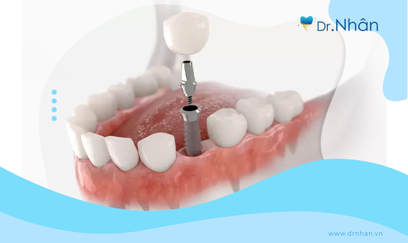 Trụ Implant được cấy vào trong xương hàm có khả năng thay thế chân răng đã mất