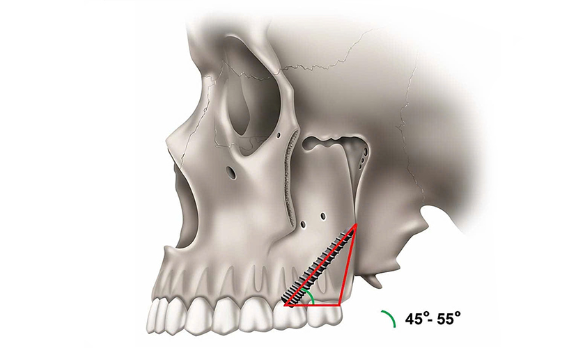 Kỹ thuật Implant xương bướm