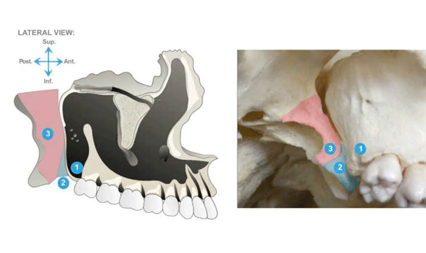 Vùng xương cánh bướm sẽ được cấy trụ implant