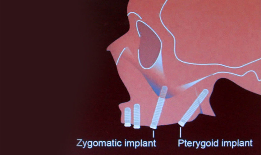 Implant xương bướm có thể kết hợp với các kỹ thuật khác để khôi phục răng mất hoàn hảo