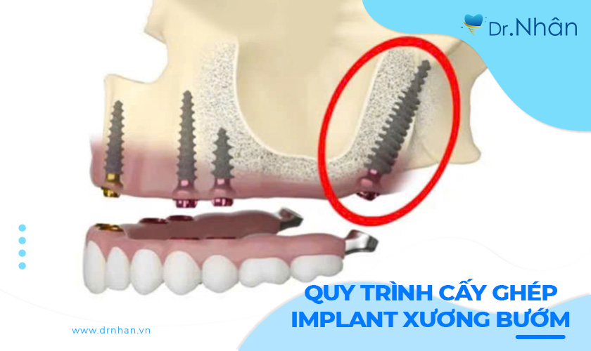 Tìm hiểu quy trình cấy ghép implant xương bướm