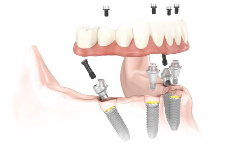 Cấy ghép Implant là giải pháp khôi phục răng mất cho người cao tuổi