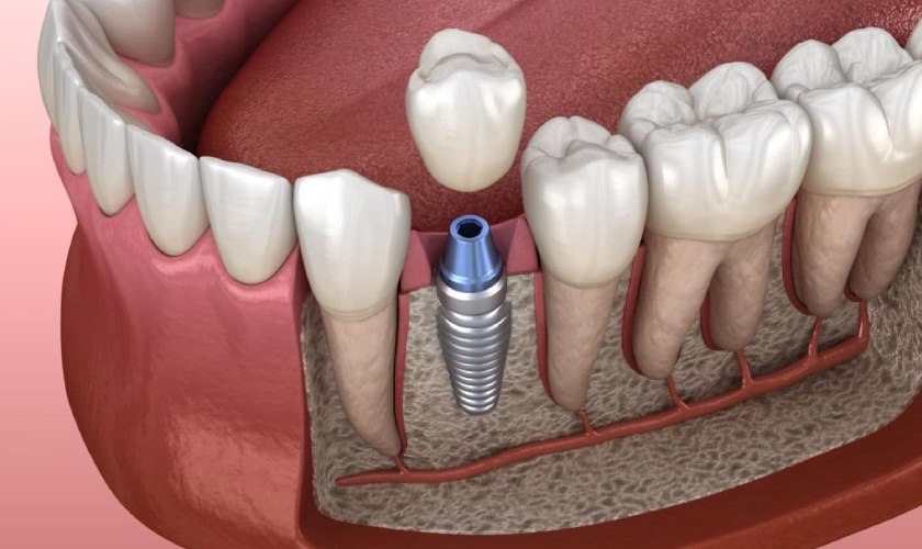 Trồng răng Implant đơn lẻ cho người mất 1 hoặc 1 vài răng không liền kề