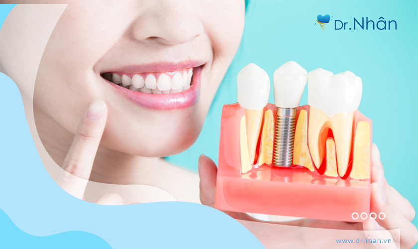 Trồng răng Implant trả góp ngày càng được nhiều người lựa chọn